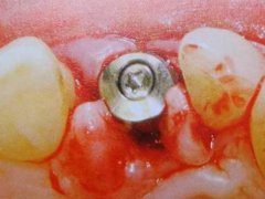 牙齿容易出血什么原因 牙齿容易流血怎么回事 牙齿容易出血