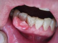 牙齿肉肿痛怎么办 牙齿酸痛是怎么回事 牙齿肉疼怎么办