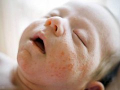 婴儿湿疹治疗(宝宝得了湿疹了怎么治疗？)