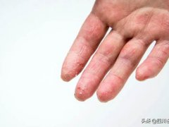 手指脱皮是什么原因(你的手为什么老脱皮？)