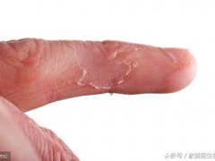 手指脱皮是什么原因(为什么你的手指总是会脱皮？)