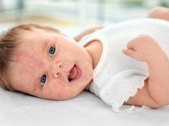 婴儿湿疹用什么药(常用于婴幼儿湿疹的五类药物)