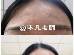 牢记5个挤痘痘步骤日常祛痘的有效方法