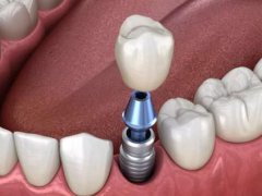 什么是种植牙？种植牙有的分类和区别你了解吗？