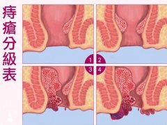 痔疮一期二期三期图片