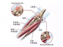 网球肘最佳治疗方法,一个让大多数人好转的办法
