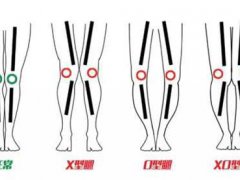 如何判断你是X型,O型,XO型腿