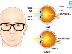 做完近视手术,我后悔了