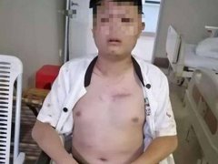 男子要求更换商品被打断12根骨头 买到发霉食品怎么赔偿