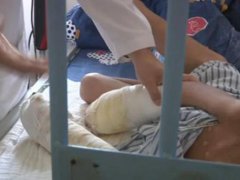 男童遭亲父烟头烫伤双手面临截肢 男童遭烫伤面临截肢