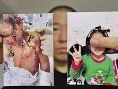 抚顺6岁被虐女童父亲望严惩前妻 6岁女童遭母亲及男友拔牙断膊
