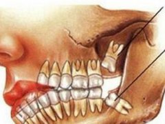 智齿一定要拔吗 最难拔的智齿图 智齿冠周炎