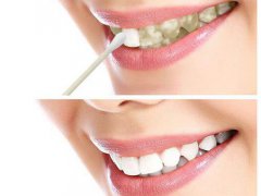 牙齿美白哪种方法好 牙齿美白小妙招 牙齿美白得多少钱