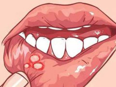 口腔溃疡吃什么好的快 口腔溃疡发病原因 口腔溃疡严重怎么办
