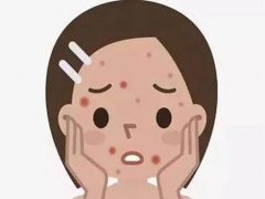 粉刺长在不同部位的原因 痘痘长在不同部位的原因