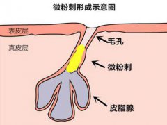 粉刺是怎么形成的 粉刺是什么意思