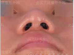 怎样让鼻翼变小(如何矫正鼻翼肥大？)