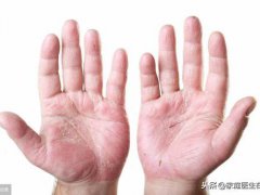 手开裂怎么办(手脚皮肤干裂怎么办？)