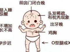 佝偻病的治疗(小孩子得了佝偻病怎么办？)