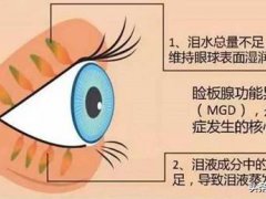 什么是干眼症？(干眼症,您了解多少?)