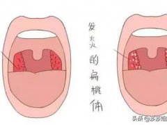 儿童扁桃体炎(孩子扁桃体发炎怎么办？)