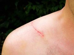 治疗疤痕最好的方法(如何有效祛除疤痕？)