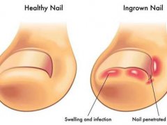 脚趾甲长肉里？(脚趾甲老长进肉里怎么办？)