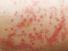 湿疹症状图片(湿疹的症状有哪些？)