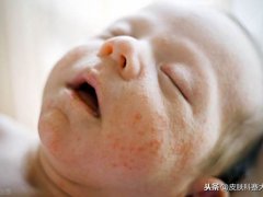 婴儿湿疹的原因(宝宝为什么会得婴儿湿疹？)