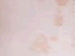 汗斑的治疗方法(什么是汗斑？能根治吗？来看看)