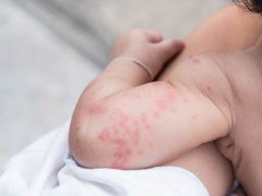 秋季荨麻疹(秋季荨麻疹发作要注意什么？)