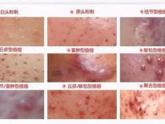 祛痘的小窍门(三个去除痘痘的方法)