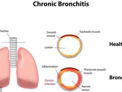 支气管炎干咳(支气管炎干咳怎么办)
