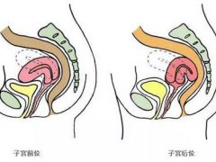 子宫后位(后位子宫影响怀孕？)