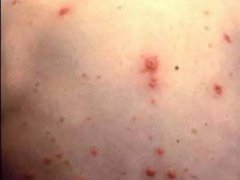 二期梅毒疹(中医治疗二期梅毒方法有哪些？)
