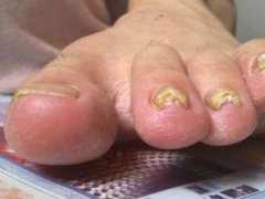 脚趾甲变厚怎么治疗(脚趾甲发黄变厚怎么办？)