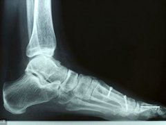 脚跟骨刺的治疗方法(足跟骨刺的治疗方法是什么？)