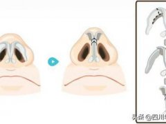 鼻翼缩小的办法(鼻翼缩小术三种常见方法)