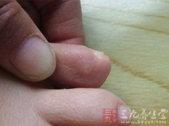 脚上鸡眼怎么办(鸡眼的预防和治疗)