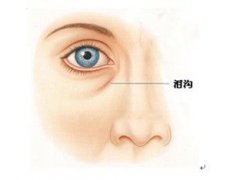 泪沟是什么！(什么是泪沟？)