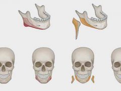 削骨手术过程是怎样的(神秘的“磨骨”手术)